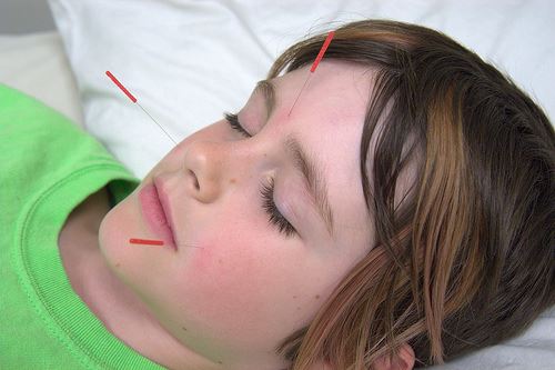 טיפול בדיקור סיני לאיפוי עין עצלה